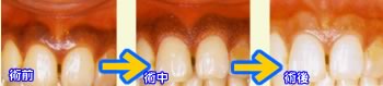 歯茎の黒ずみを取り除く治療の経過写真